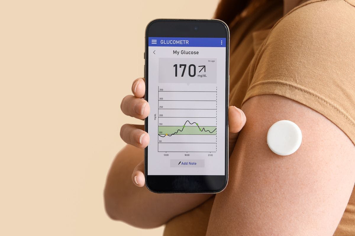 woman with cgm glucose monitor blood sugar: © Pixel-Shot - stock.adobe.com